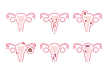 Illustration of uterine disease