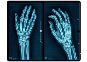 Hand X-ray - obrazy, fototapety, plakaty