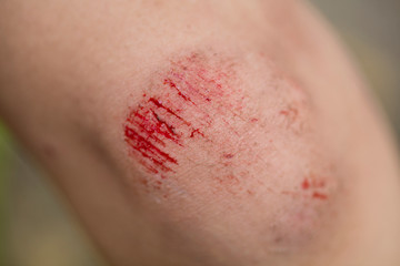 Close up wound on knee from accident, healthcare and medicine concept