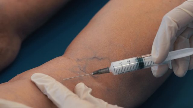 Treatment of varicose veins with injections. An injection into a vein in the leg. Dilated varicose veins in the legs