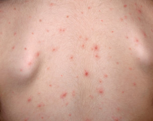 Fototapeta premium Chickenpox disease. Boy sick on his back . Chickenpox virus, chicken pox outbreak in children. Concept of contagion.