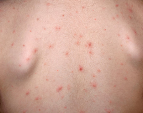 Chickenpox disease. Boy sick on his back . Chickenpox virus, chicken pox outbreak in children. Concept of contagion.