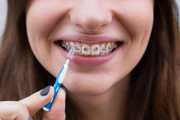 Beautiful young girl with metal braces for teeth with white teeth and brush