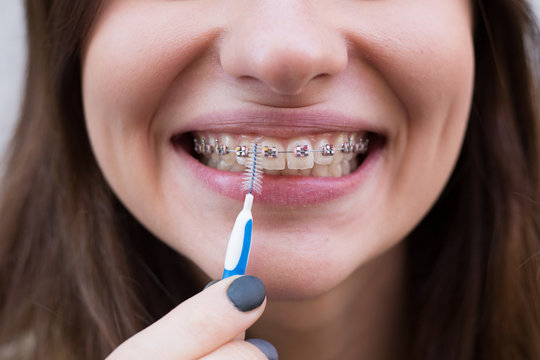 Beautiful young girl with metal braces for teeth with white teeth and brush