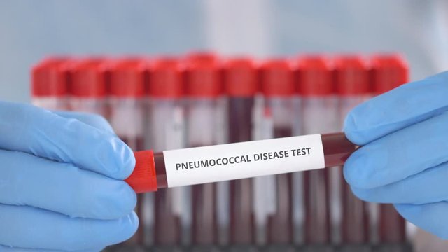 Laboratory assistant wearing protection gloves holds vial with pneumococcal disease test