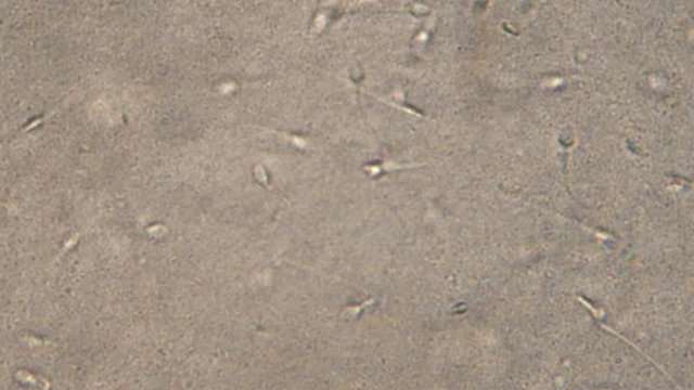 Microscopy of human sperm . Magnification 300x  moving of spermatozoides in detail under microscope.