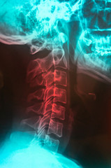 Cervical spine skeleton x-ray film of a patient with military neck or straight neck, medical concept photo