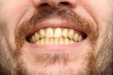 A white man with a beard and mustache shows clenched teeth. Close-up part of the face, yellowish...