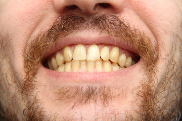 A white man with a beard and mustache shows clenched teeth. Close-up part of the face, yellowish teeth, cheeks, nose and chin. Medicine, oral health