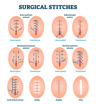 Surgical stitches vector illustration. Labeled various cut injury treatment