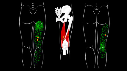 Trigger points and reflected pain in the hamstring muscles