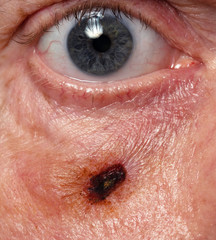 Wound on causian male cheek after removal of suspected skin cancer spot seen from front