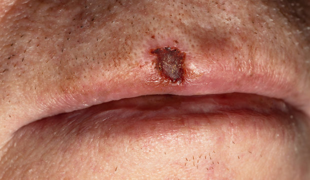 Wound on caucasian male upper lip after removal of skin suspected cancer spot