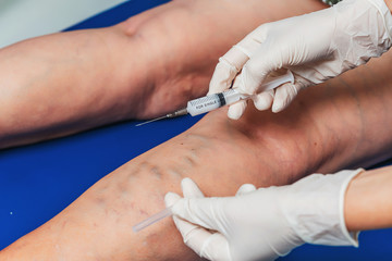 Injections into the veins of an elderly woman's leg close-up. Doctor's injections in the veins of...