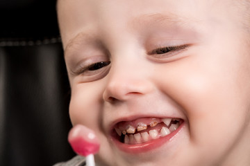 kid patient open mouth showing caries teeth decay. Dental medicine and healthcare. caries from an early age