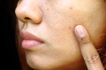 close up wide pores on oily face skin, nose and mouth which have problem skin of asia woman by...