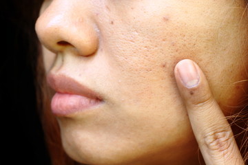 close up wide pores on oily face skin, nose and mouth which have problem skin of asia woman by woman use finger point focus problem on face on black background