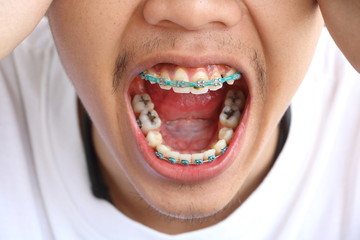 Close up Asian man teeth was braces have food scraps attached, concept unclean braces