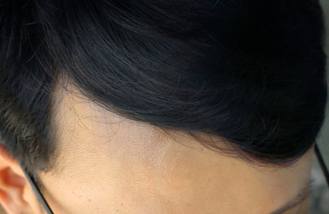 Closeup Asian man hair on her forehead, hormone adult can make him hair fall down and he can glabrous or bald head.