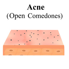 Open comedones. Acne on the skin. Dermatological and cosmetic diseases on the skin of the face acne. Infographics. Vector illustration on isolated background.