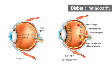 Diabetic retinopathy. Difference between Normal Retina and Diabetic Retinopathy