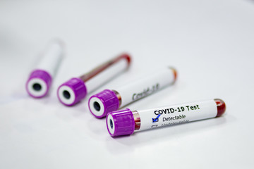 Blood sample tube of coronavirus or covid-19 disease. Medical and microbiologist science concepth photo.