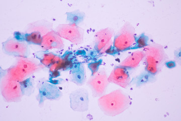 Fototapeta na wymiar View in microscopic of Candidiasis, fungus infection (Yeast and Pseudohyphae form) in pap smear slide cytology and diagnostic by pathologist.Gynecology report and diagnosis.Medical concept.
