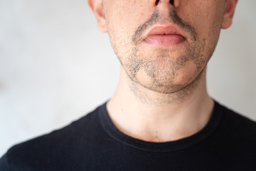 Close up of alopecia areata on a man's beard - obrazy, fototapety, plakaty