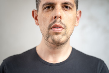 Fototapeta premium Close up of alopecia areata on a man's beard