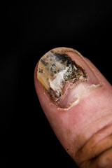 Onycholysis, Detachment Of Nail From Nailbed