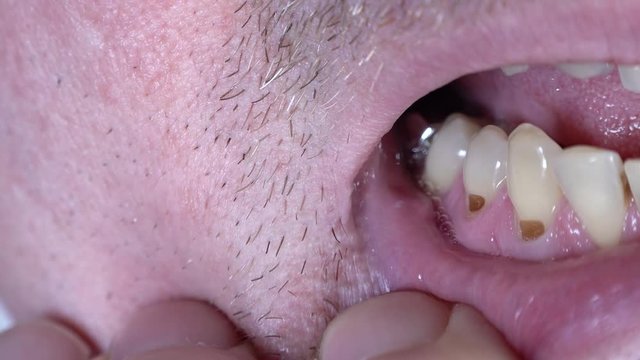 Close up footage of tooth necks exposed