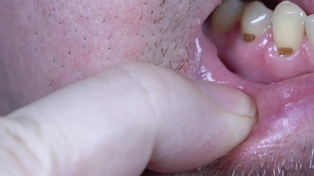 Close up footage of tooth necks exposed