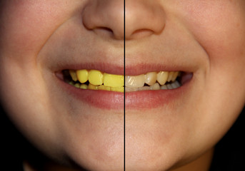 Colored teeth. Bacteria and microbes on your teeth.