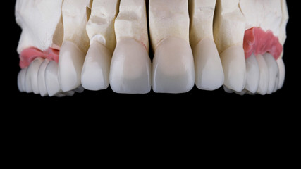 ceramic veneers and crowns of the upper jaw on a black background