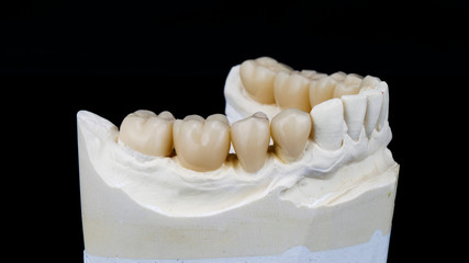 dental zircon crowns for the lower jaw on a gypsum model, shot on a black background