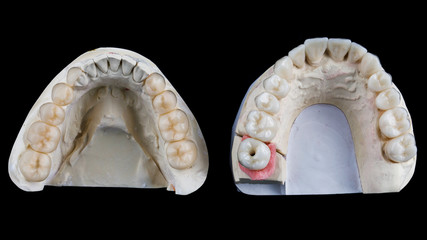 set of ceramic crowns total work, top view on a black background
