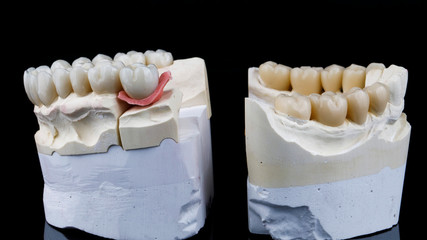 set of ceramic and zircon crowns on dental models from plaster on a black background