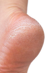 female heel with dry, cracked, damaged skin of the foot close-up isolated on a white background