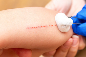 Treating scratches on a child, kid hand with a cotton swab
