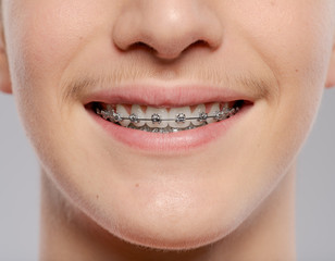 Naklejka premium Teeth of a young man with braces on his teeth close-up.
