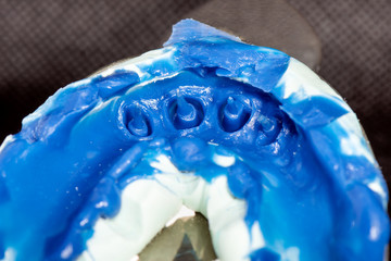 silicone tooth print for the manufacture of a blue tooth pin and tooth crown. Restoration of a man’s smile in a dental clinic