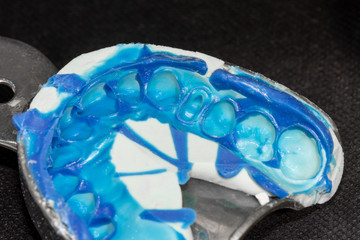 silicone tooth print for the manufacture of a blue tooth pin and tooth crown. Restoration of a man’s smile in a dental clinic