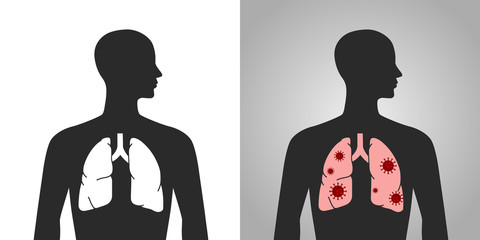 新型コロナウイルスと肺の人体図
