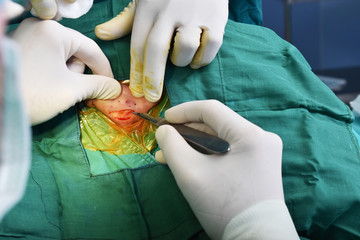 The surgeon used a knife to slit the ear. In order to remove the cartilage behind the ear