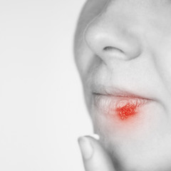 Girl with herpes. Sick mouth symptom. Lips cold. Red round concept. Finger near head. Woman face. Healthcare infection. Close view