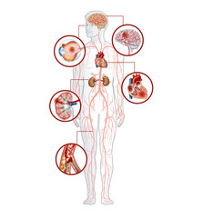 Hypertension, high blood pressure, medical illustration