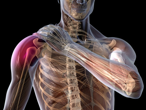Painful shoulder joint, rheumatoid arthritis, medical 3D illustration