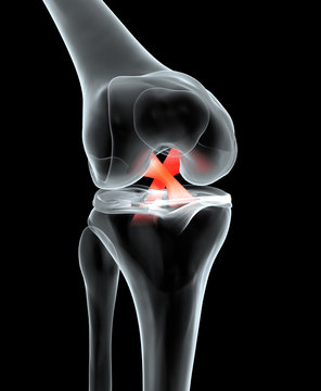 Painful Knee Joint With Highlighted Anterior And Posterior Cruciate Ligament, Medically 3D Illustration