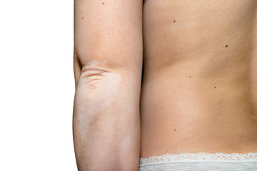 Stains from vitiligo disease on the elbows of a young Caucasian woman, isolated on a white background with a clipping path.