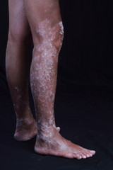 skin diseases - psoriasis on the legs